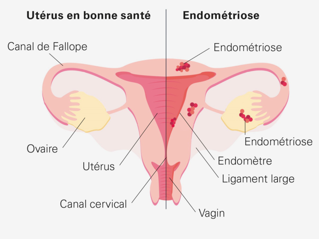 endométriose